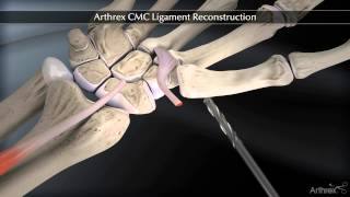 Arthrex CMC Ligament Reconstruction [upl. by Lirrehs]