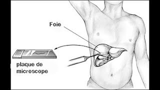 VOUS SAVEZ LA BIOPSIE HEPATIQUE [upl. by Terrye]