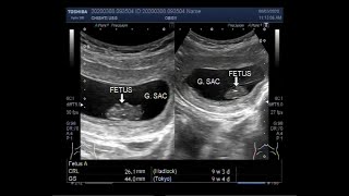 Ultrasound Video showing Missed abortion or Missed miscarriage [upl. by Annabella]