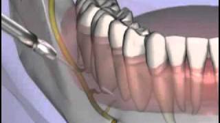 Malameds Local Anesthesia 11 Supplemental Injection Techniques [upl. by Annahsohs190]