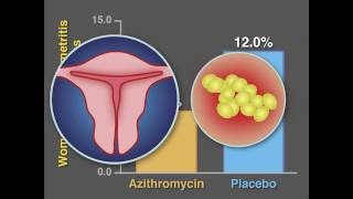 Ureaplasma Infection what you need to consider [upl. by Mulry]