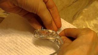 Herbst Appliance TMJ Surgery [upl. by Brendan547]