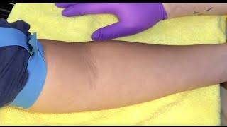 Tips For Locating Difficult Veins [upl. by Cho984]