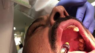 Palatal Anesthetic Infiltration Technique [upl. by Frye]