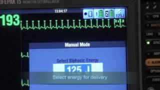 Synchronized Cardioversion [upl. by Vasti]