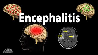 Encephalitis Animation [upl. by Devon445]