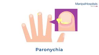 What is Paronychia and Its Treatment  Manipal Hospitals India [upl. by Anselme405]