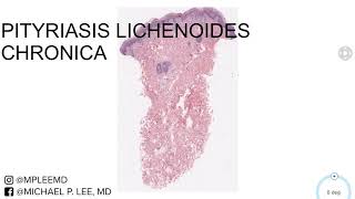 Pityriasis Lichenoides Chronica Dermpath Made Easy [upl. by Ainala335]