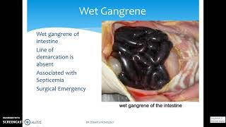 DIFFERENT TYPES OF GANGRENE [upl. by Ortiz491]