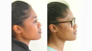 How Orthodontic Extractions can change Facial Profiles [upl. by Seftton]