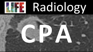 Radiology of chronic pulmonary aspergillosis [upl. by Gnues]